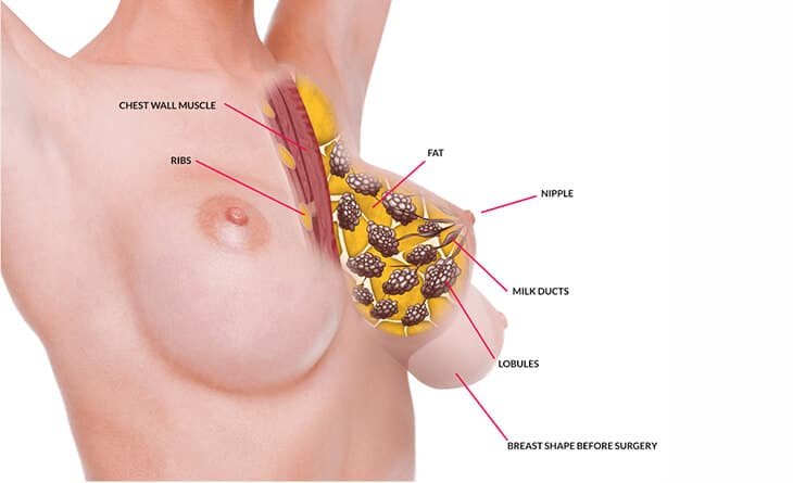 Breast Lift - Dr Rajat Gupta - 02 breast lift procedure