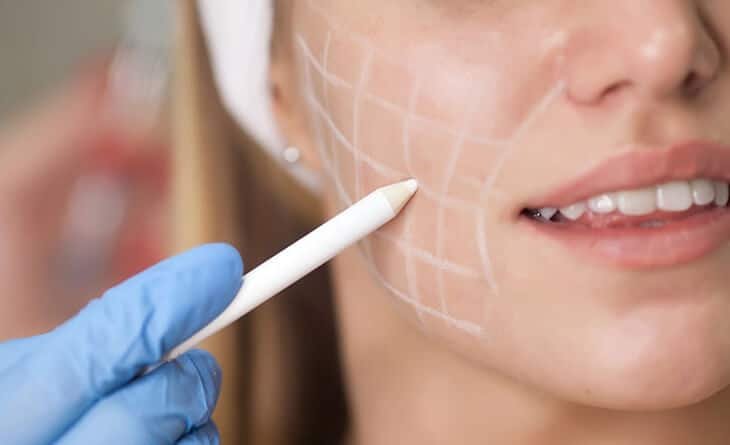 Buccal Pad Fat Removal - Dr Rajat Gupta - Plastic Surgeon in Delhi -02 Buccal Pad Fat Removal