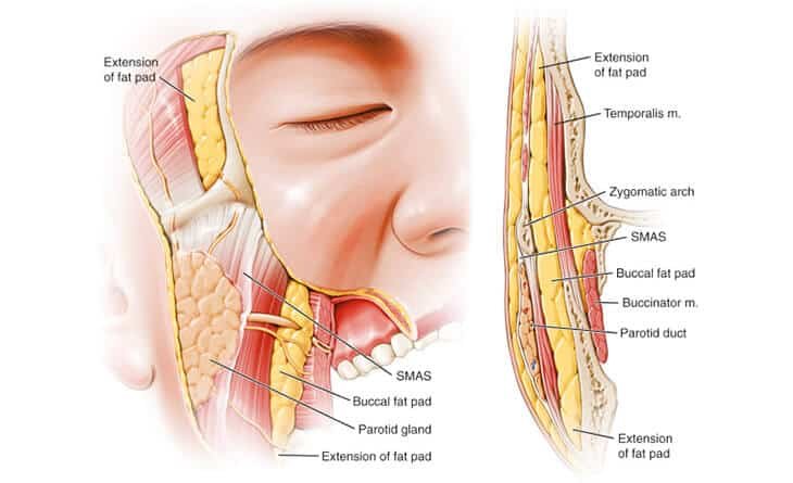 Buccal Pad Fat Removal - Dr Rajat Gupta - Plastic Surgeon in Delhi -03 Buccal Pad Fat Removal in delhi
