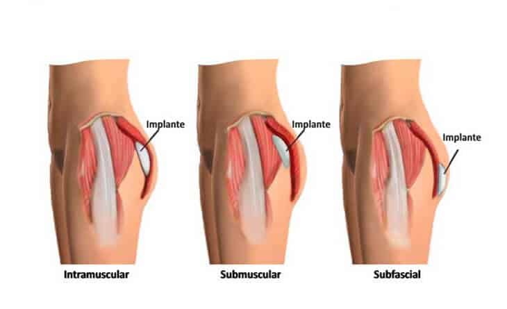 Buttock Augmentation - Dr Rajat Gupta - Plastic Surgeon in Delhi -02 Buttock Augmentation Procedure