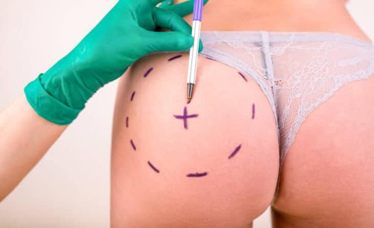Buttock Augmentation - Dr Rajat Gupta - Plastic Surgeon in Delhi -03 Buttock Augmentation Procedure