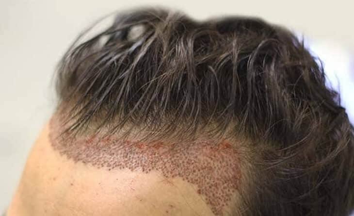 Hair Transplant- Dr Rajat Gupta - Plastic Surgeon-02 (1) Hair Transplant in Delhi