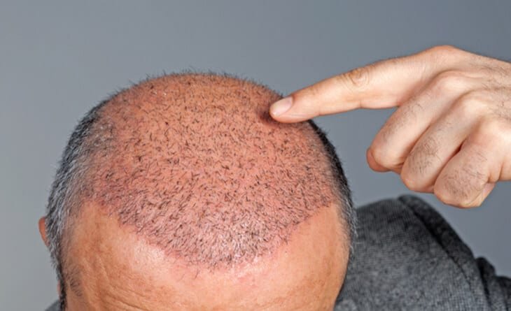 Hair Transplant - Dr Rajat Gupta - Plastic Surgeon in Delhi -01 hair transplant