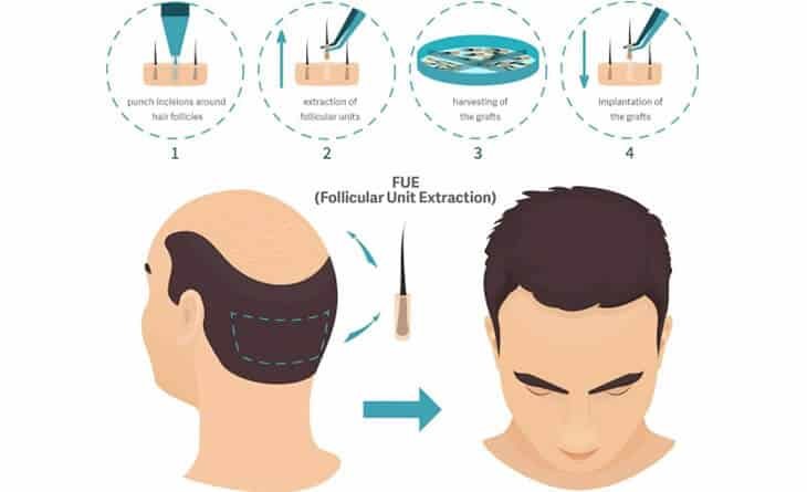 Hair Transplant - Dr Rajat Gupta - Plastic Surgeon in Delhi -03 hair transplant