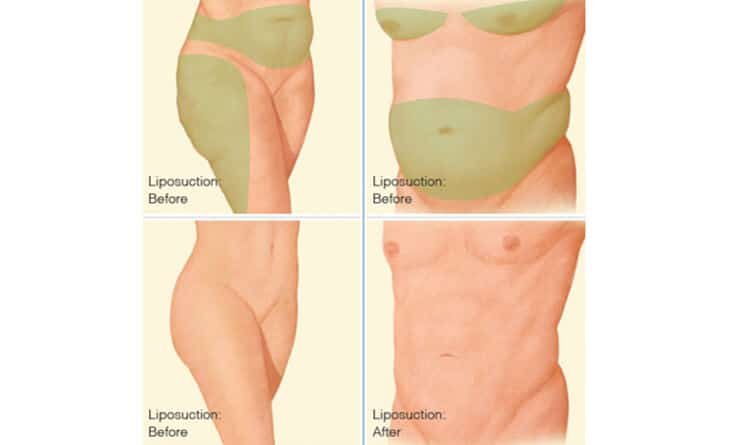 Liposuction Surgery- Dr Rajat Gupta - Plastic Surgeon Liposuction Surgery in Delhi