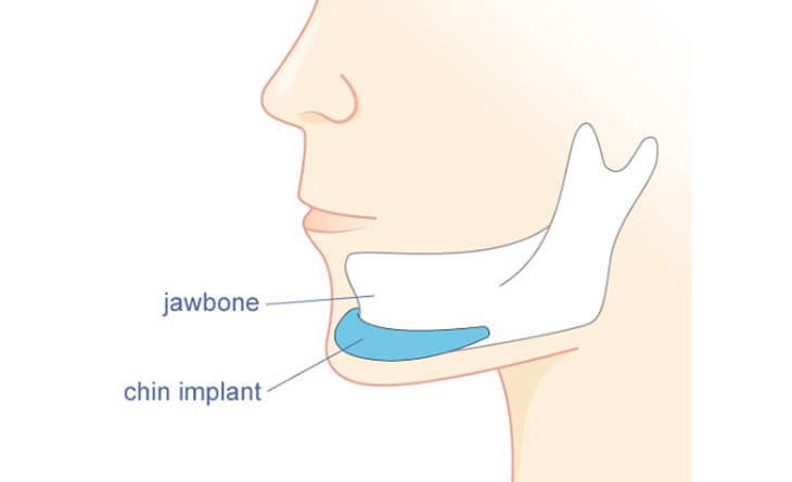 chin augmentation procedure - Dr Rajat Gupta - Plastic Surgeon in Delhi -01 (1) Chin augmentation in Delhi