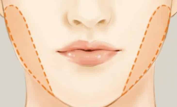 Buccal Pad Removal - Dr rajat gupta - Plastic Surgeon n Delhi - 02 Buccal Pad Removal