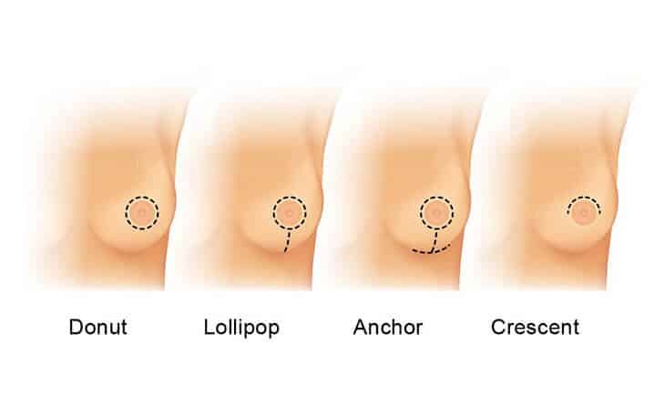 Cost of Breast Uplift and Implants - Dr Rajat Gupta - 02 Breast Implant Cost in Delhi