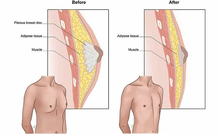 Bras-For-Severe-Gynecomastia-Dr-Rajat-Gupta-02 Gynecomastia Surgery