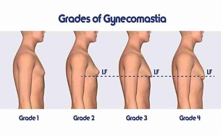 Gynecomastia-surgery-Dr-Rajat-Gupta-Plastic-Surgeon-in-delhi-02 Gynecomastia Surgery in delhi