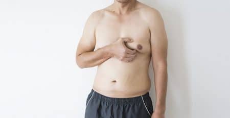 Gynecomastia