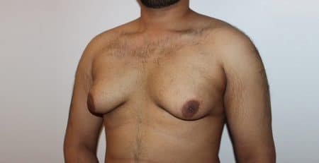 Gynecomastia