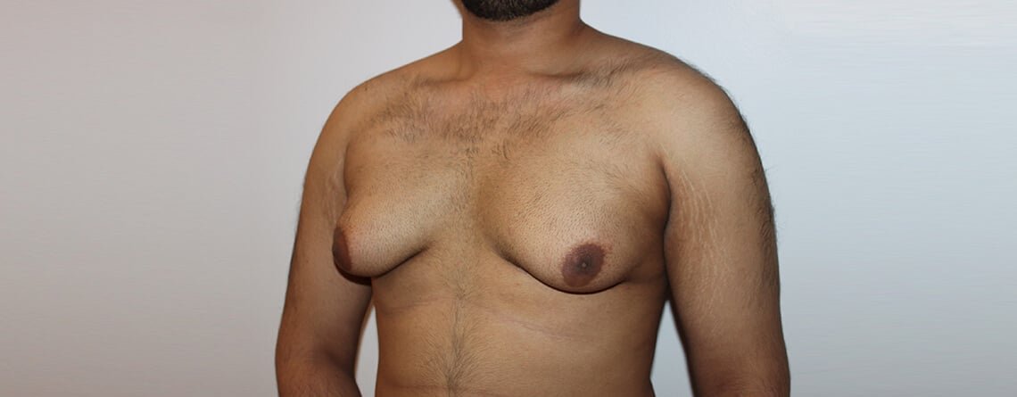 Gynecomastia