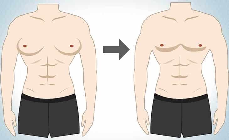 Side effects after gynecomastia surgery - Dr Rajat Gupta -013 Gynecomastia Surgery