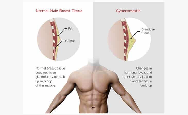 Treatment-of-gynecomastia-in-Ayurveda-Dr-Rajat-Gupta-Plastic-Surgeon-in-Delhi-02 Gynecomastia surgery bruising