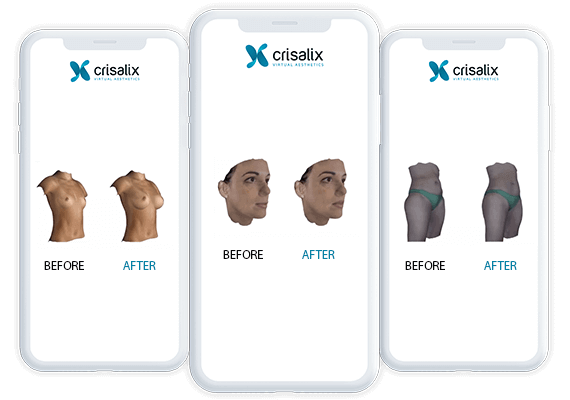 crisalix-570x400-1