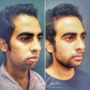 chin augmentation