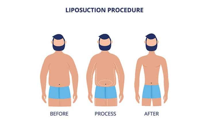 Liposuction Procedure - Dr Rajat Gupta - Plastic Surgeon in Delhi -02 Liposuction Procedure