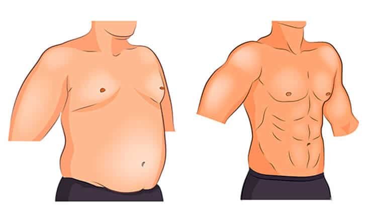 Can Exercise Reduce Gynecomastia - Dr Rajat Gupta - Plastic Surgeon in Delhi -232 Gynecomastia Surgery in Delhi