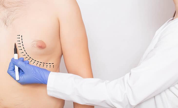 Understanding Gynecomastia - Dr Rajat Gupta - Plastic Surgeon in Delhi -12 Understanding Gynecomastia in Your 30's