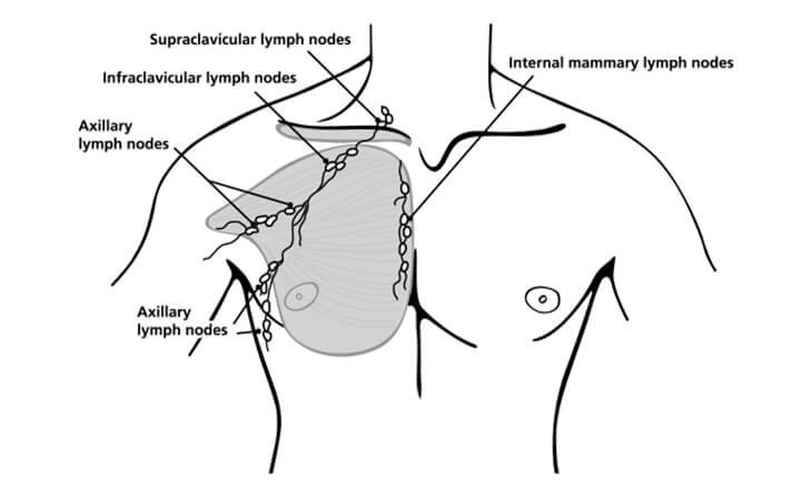 Can Gynecomastia Turn Into Cancer - Dr Rajat Gupta -012 gynecomastia surgery in delhi