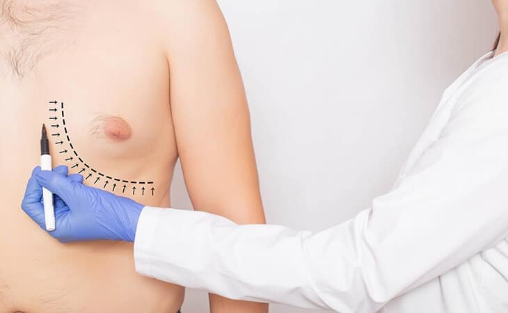 Can You Have Alcohol After Gynecomastia Surgery - Dr Rajat Gupta - Plastic Surgeon in Delhi -012 Gynecomastia Surgery