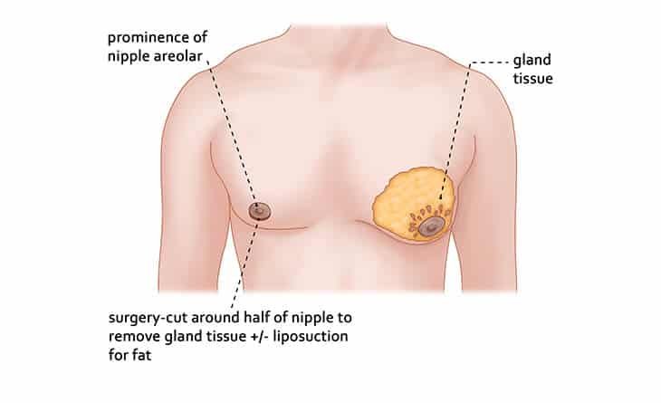 How Gynecomastia Glandular Tissue Removal is Done - Dr Rajat Gupta -0134 gynecomastia surgery in delhi