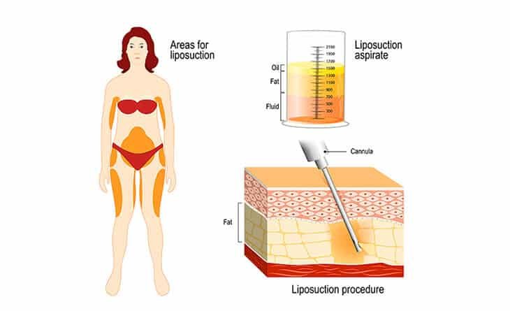 Do Liposuction Scars Go Away - Dr Rajat Gupta -02 liposuction surgery