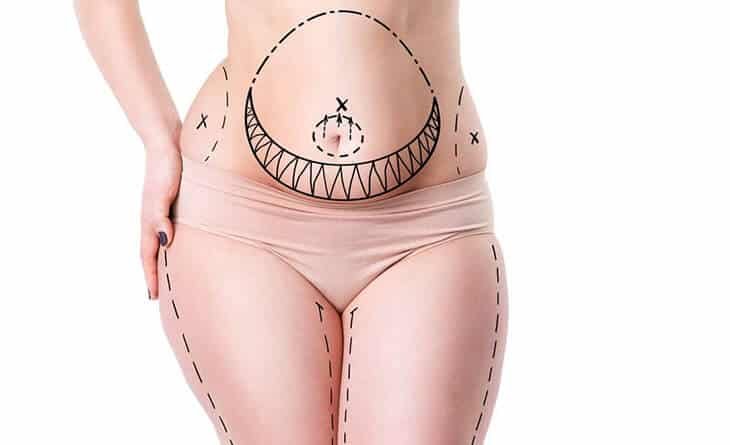 Liposuction on the Hips - Dr Rajat Gupta -012 liposuction surgery in delhi