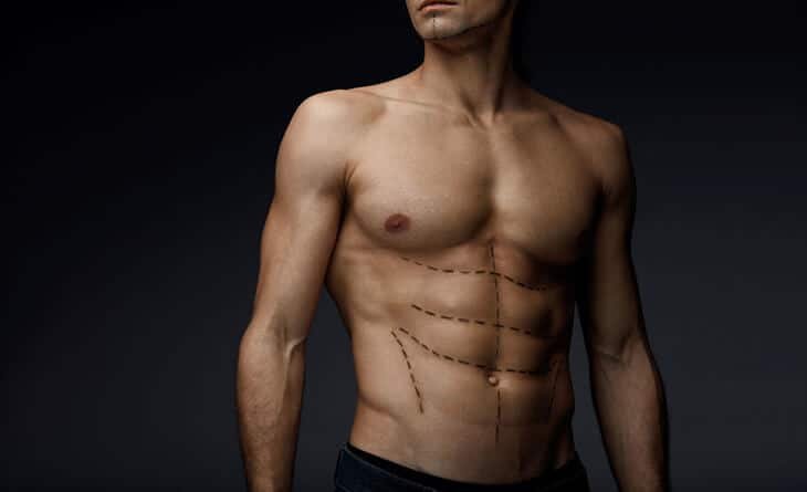 Men Benefit from Full Body Liposuction Surgery - Dr Rajat Gupta - Plastic Surgeon in Delhi 089 liposuction surgery in delhi