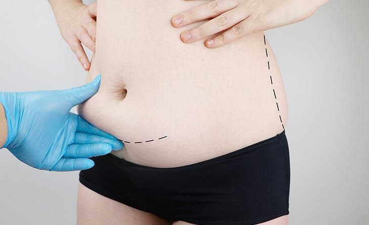 Can You Get a Tummy Tuck and Caesarean Section - Dr Rajat Gupta - 012 tummy tuck surgery