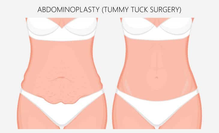 How Much Does Circumferential Tummy Tuck Cost - Dr Rajat Gupta -0124 Tummy tuck surgery
