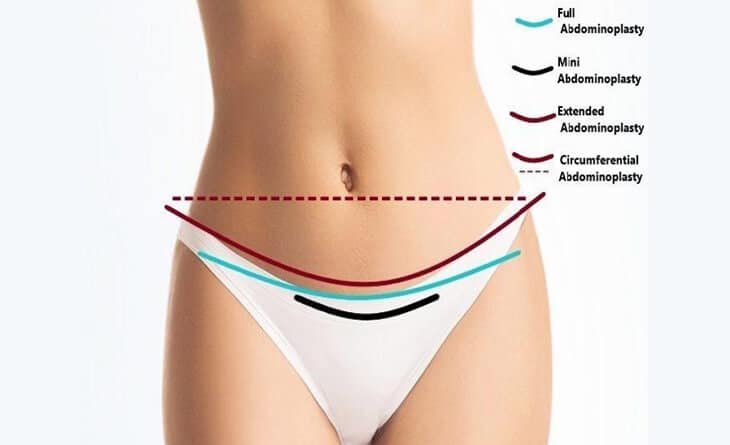 What are the After-Effects of a Tummy Tuck - Dr Rajat Gupta -893 Tummy Tuck Surgery in Delhi