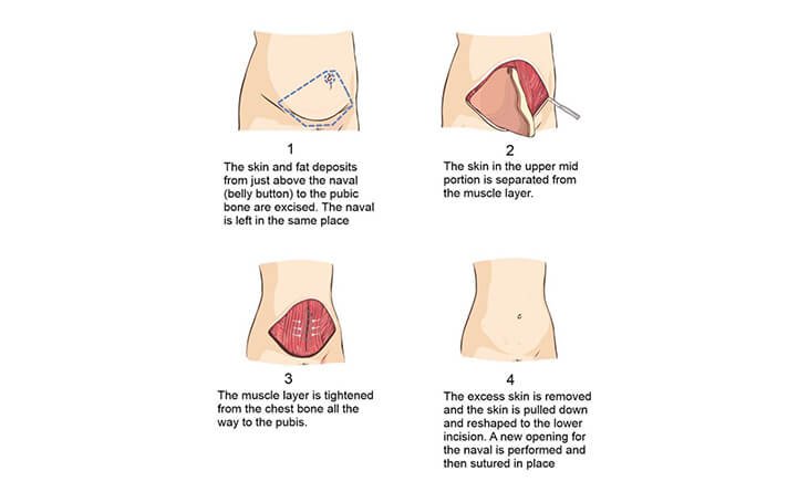 What are the Different Types of Tummy Tucks - Dr Rajat Gupta -99 tummy tuck surgery