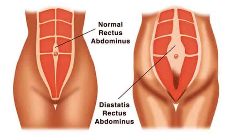 What to Expect When Searching for Tummy Tuck Prices Near Me - Dr Rajat Gupta -012 Tummy Tuck Surgery in Delhi