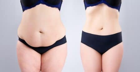 Tummy Tuck Surgery in Delhi
