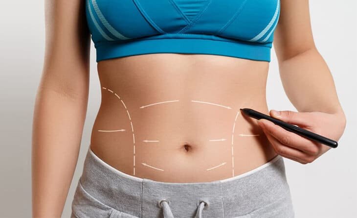 Is It Safe to Do Tummy Tuck and Caesarian Section Simultaneously - Dr Rajat Gupta -910 Tummy tuck surgery