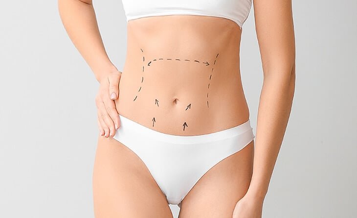 Is There a Tummy Tuck Alternative for Excess Skin - Dr Rajat Gupta -892 tummy tuck surgery in delhi