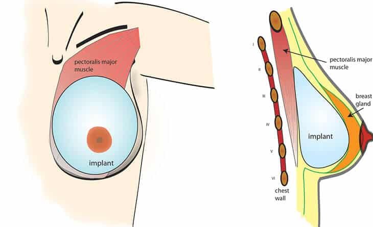 Do I Get Back Pain After Breast Augmentation Surgery - Dr Rajat Gupta 013 Do I Get Back Pain After Breast Augmentation Surgery?