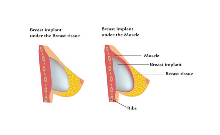 What is the Latest Technology in Breast Augmentation Surgery - Dr Rajat Gupta 078 What is the Latest Technology in Breast Augmentation Surgery?