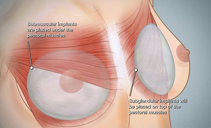 dr rajat gupta - How Long is the Breast Augmentation Healing Time 91 How Long is the Breast Augmentation Healing Time?