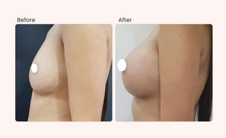 Ultimate Guide for Breast Enhancement - Dr Rajat Gupta - Plastic Surgeon in Delhi -03