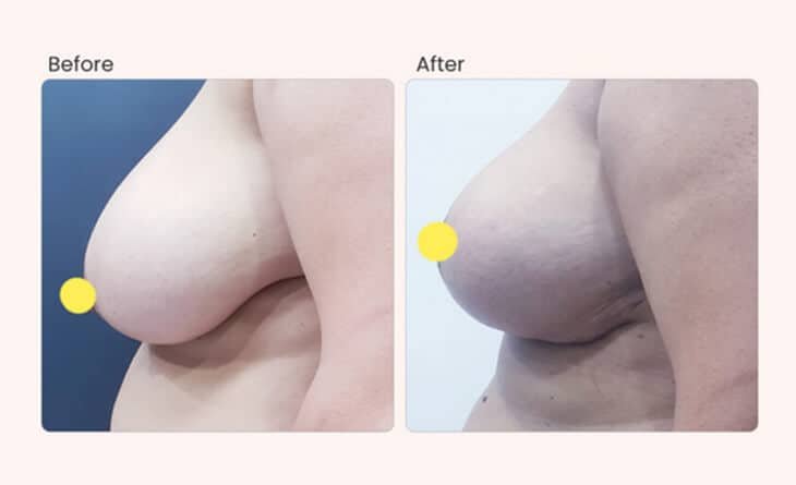 Ultimate Guide for Breast Enhancement - Dr Rajat Gupta - Plastic Surgeon in Delhi -05