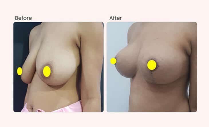 Ultimate Guide for Breast Enhancement - Dr Rajat Gupta - Plastic Surgeon in Delhi -07