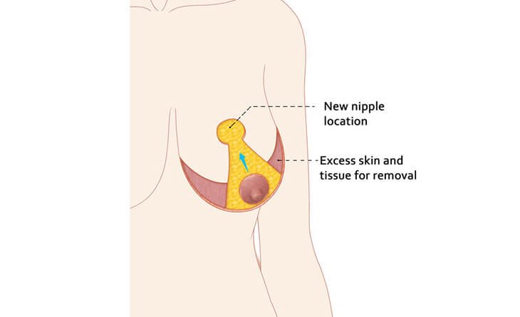 Which is Better - Breast Reduction Liposuction or Surgery - Dr Rajat Gupta -012 Breast Reduction Liposuction or Surgery