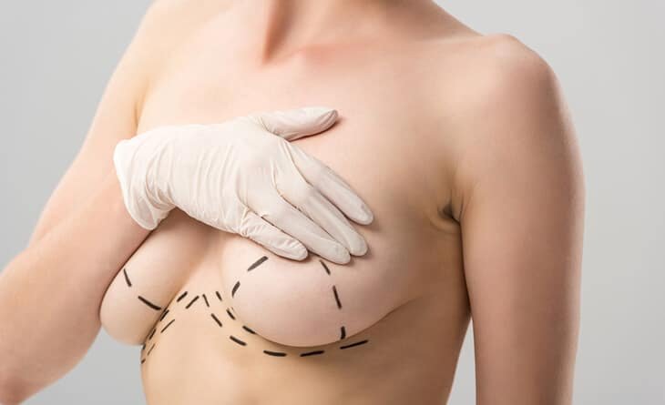 Which is the Right Bra After Breast Reduction Surgery - Dr Rajat Gupta -01 post-surgery compression garment
