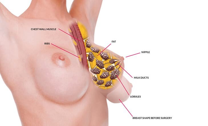How Can I Get Scarless Breast Lift Surgery - Dr Rajat Gupta - Plastic Surgeon in Delhi -012 Scarless Breast Lift Surgery