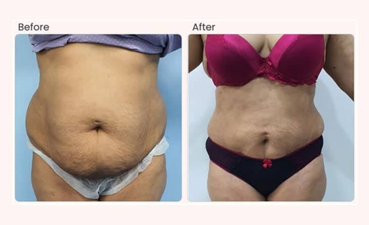 Before After Liposuction - Ultimate Guide for Abdominoplasty - Dr Rajat Gupta - Plastic Surgeon in Delhi -012 Liposuction surgery