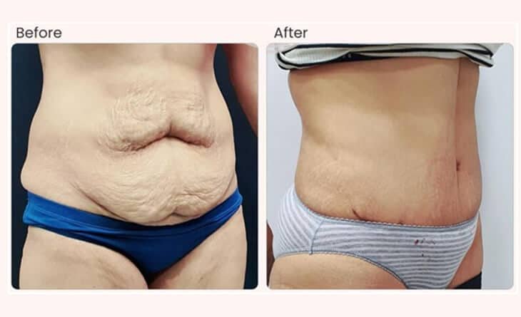 Before After Tummy tuck - Ultimate Guide for Abdominoplasty - Dr Rajat Gupta - Plastic Surgeon in Delhi -012