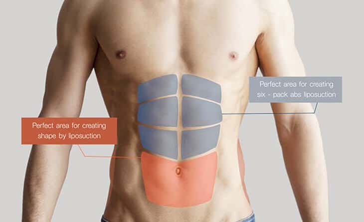 Complete Guide to 6 Pack Abs Surgery - Abdominal Etching - Six Pack Abs Surgery in Delhi - Dr Rajat Gupta - Best Plastic Surgeon in Delhi 01 6 Pack Abs surgery